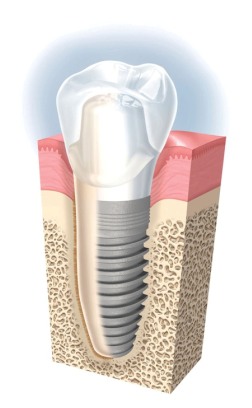 implantes dentales madrid